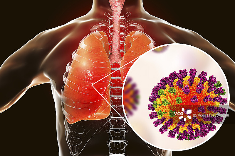 流感引起的肺炎插画图片素材