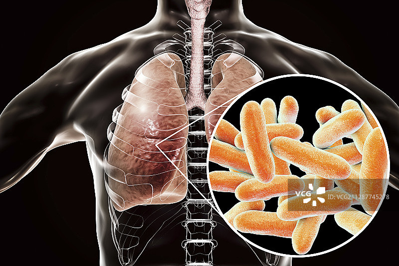 军团菌病概念图图片素材