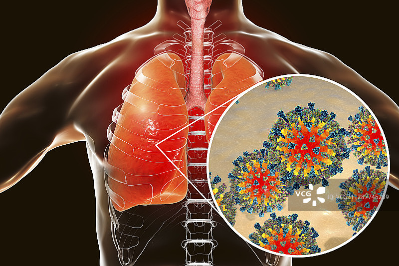 麻疹病毒引起的肺炎概念图图片素材
