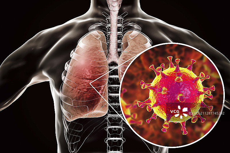 中东呼吸综合征病毒感染肺部概念图图片素材