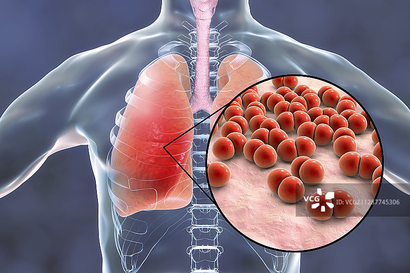 肺炎链球菌引起的肺炎概念图图片素材