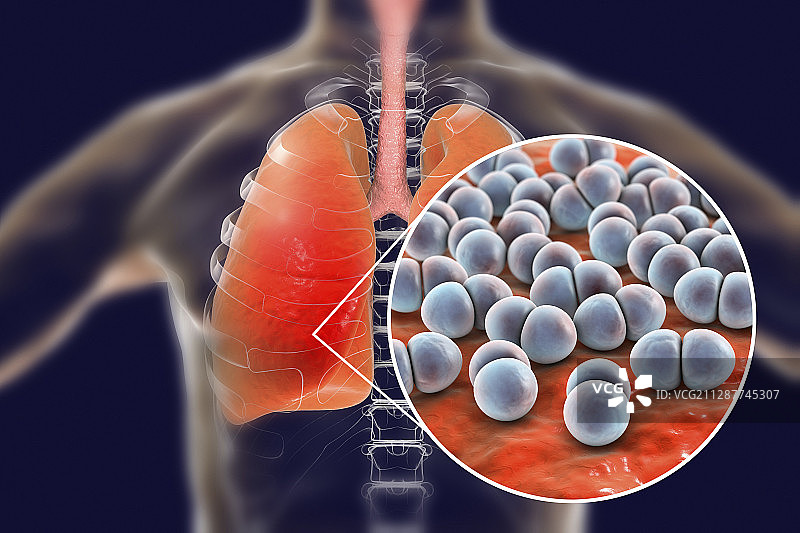 肺炎链球菌引起的肺炎概念图图片素材