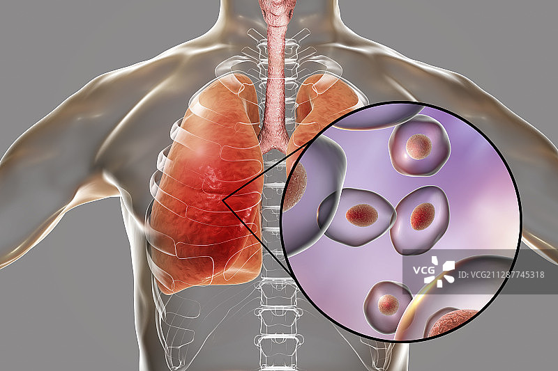 肺孢子菌肺炎概念插图图片素材