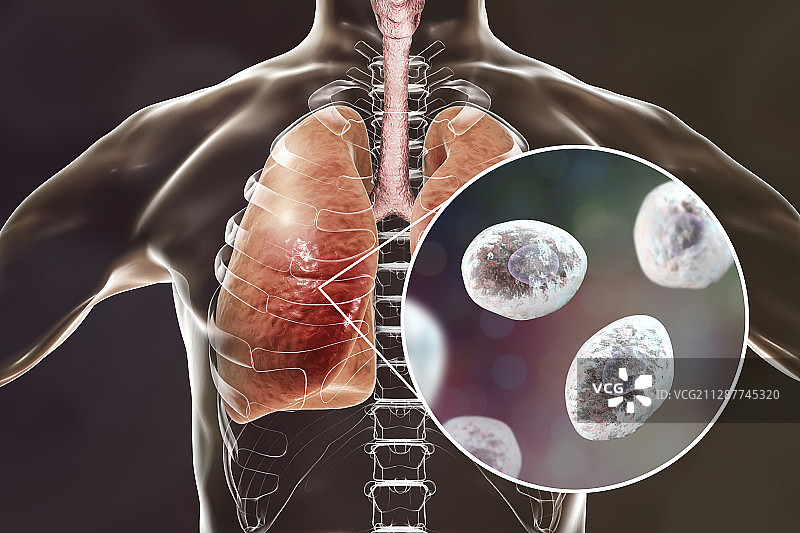 肺孢子菌肺炎概念插图图片素材