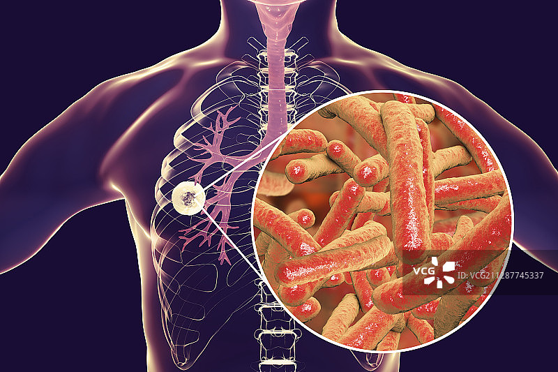 空洞型肺结核插画图片素材