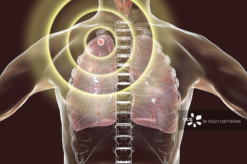 结核病的治疗和预防概念插图图片素材