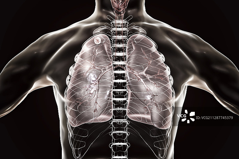肺尖结节继发性肺结核感染插图图片素材