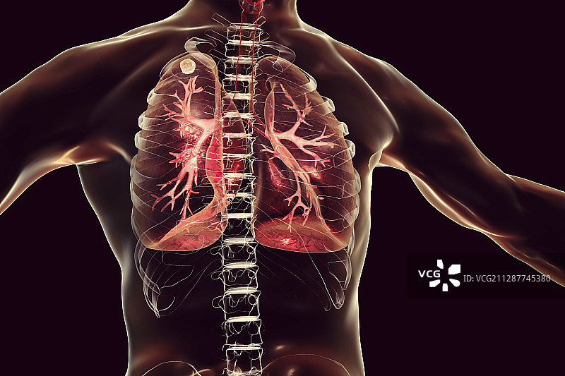 肺尖结节继发性肺结核感染插图图片素材