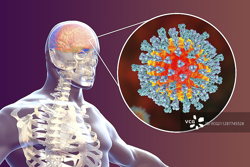 麻疹病毒引起的脑炎插图图片素材