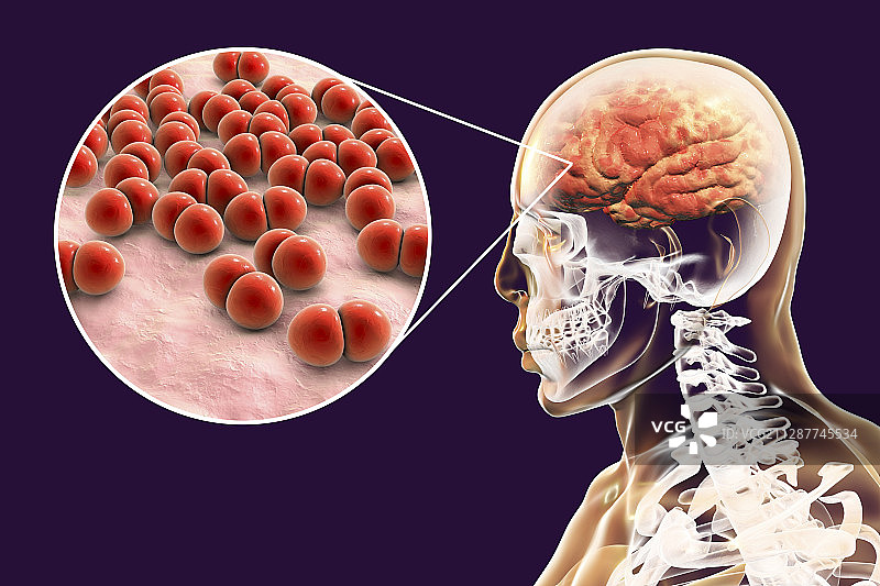 由链球菌引起的大脑感染插图图片素材