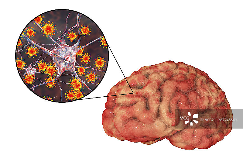 病毒性脑炎，插图图片素材