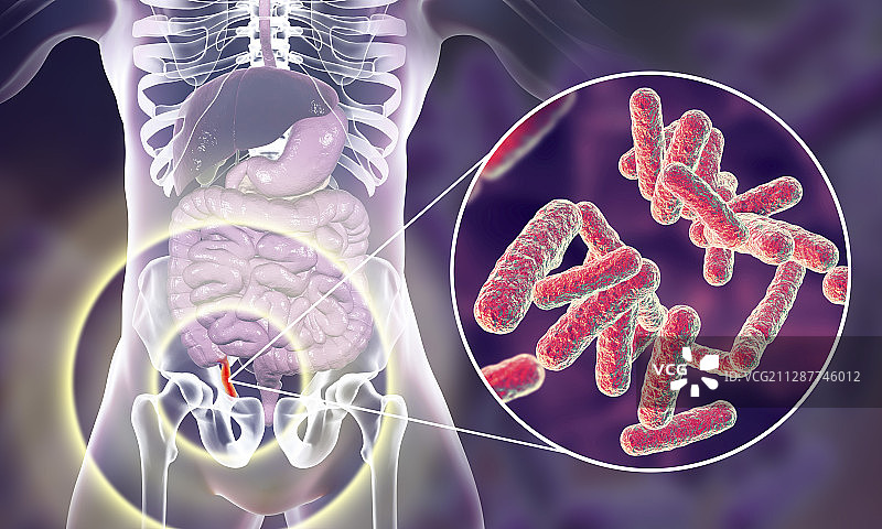 阑尾炎插图图片素材