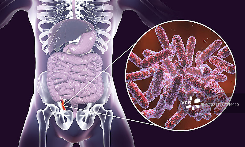 阑尾炎插图图片素材