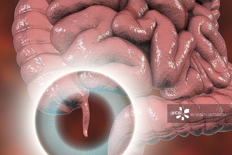 人的阑尾插图图片素材