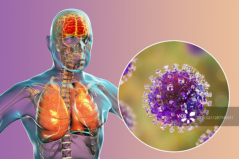 尼帕病毒引起的脑炎图片素材