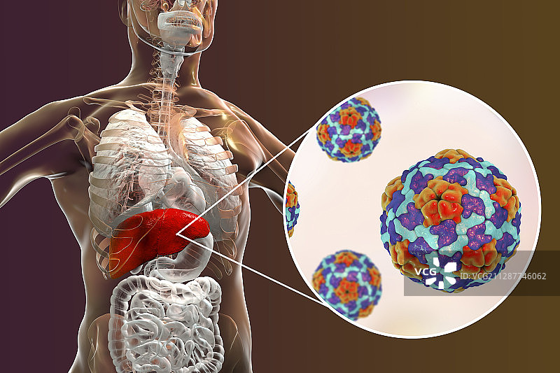 甲型肝炎感染插图图片素材