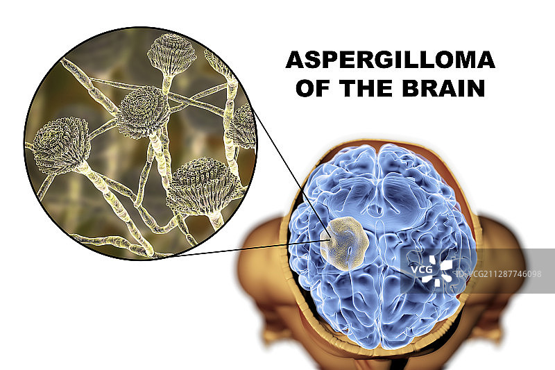 脑曲霉菌球图示图片素材