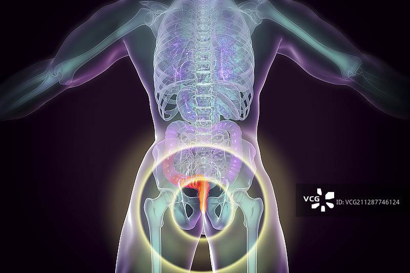 痔疮插图图片素材