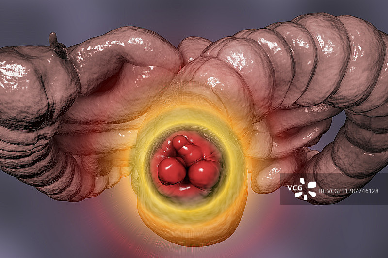 痔疮插图图片素材