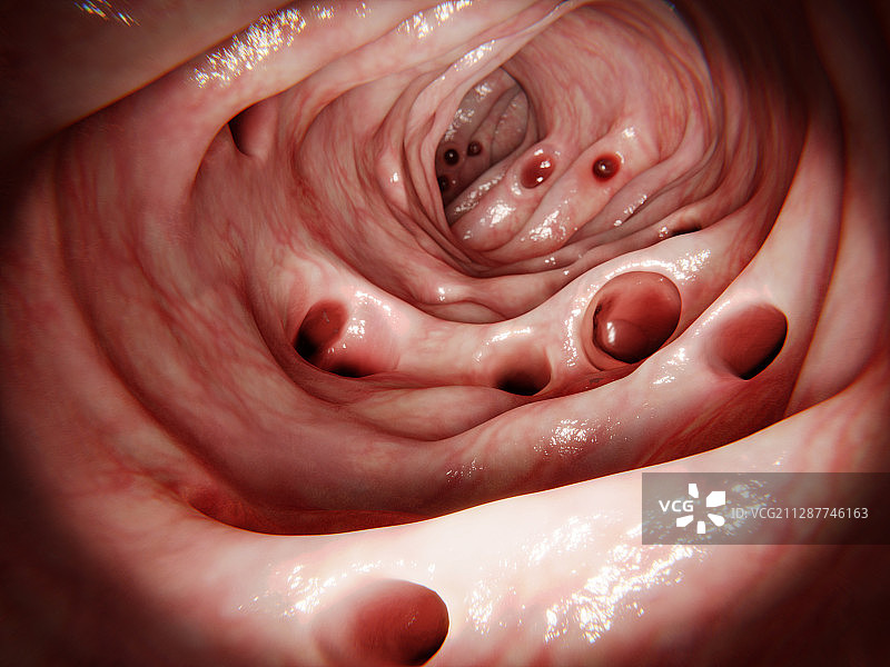 大肠憩室病图示图片素材