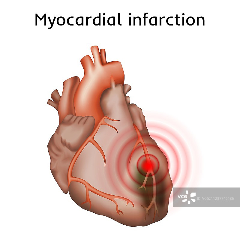 心脏病发作插画图片素材