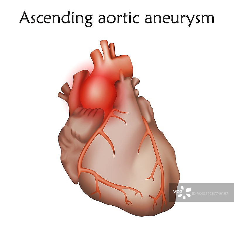 升主动脉瘤插图图片素材