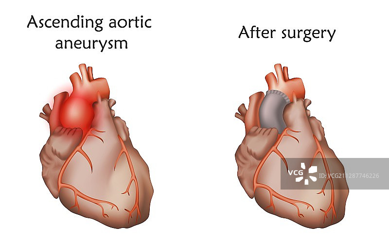 升主动脉动脉瘤治疗图示图片素材