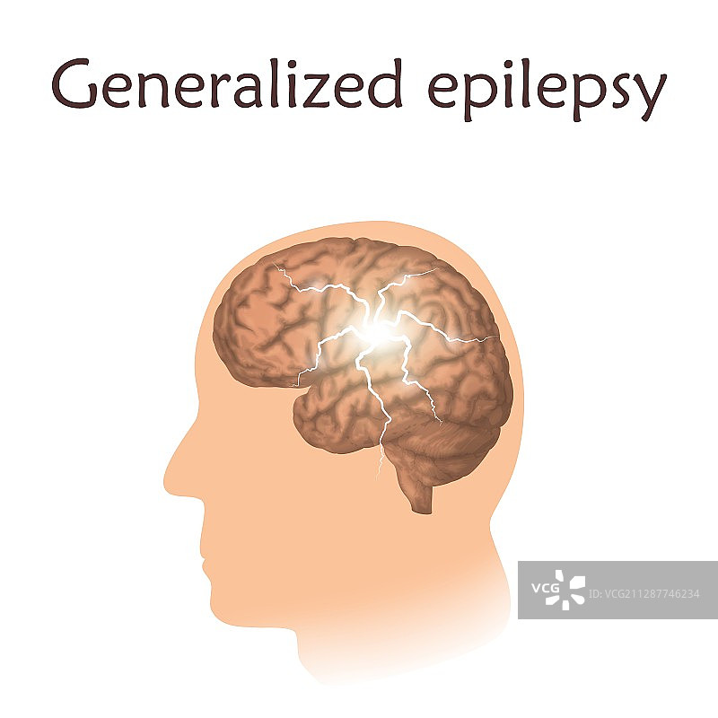 局灶性癫痫示意图图片素材