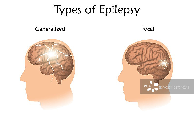 癫痫类型图解图片素材