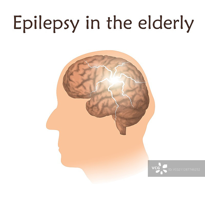 老年人癫痫，图示图片素材