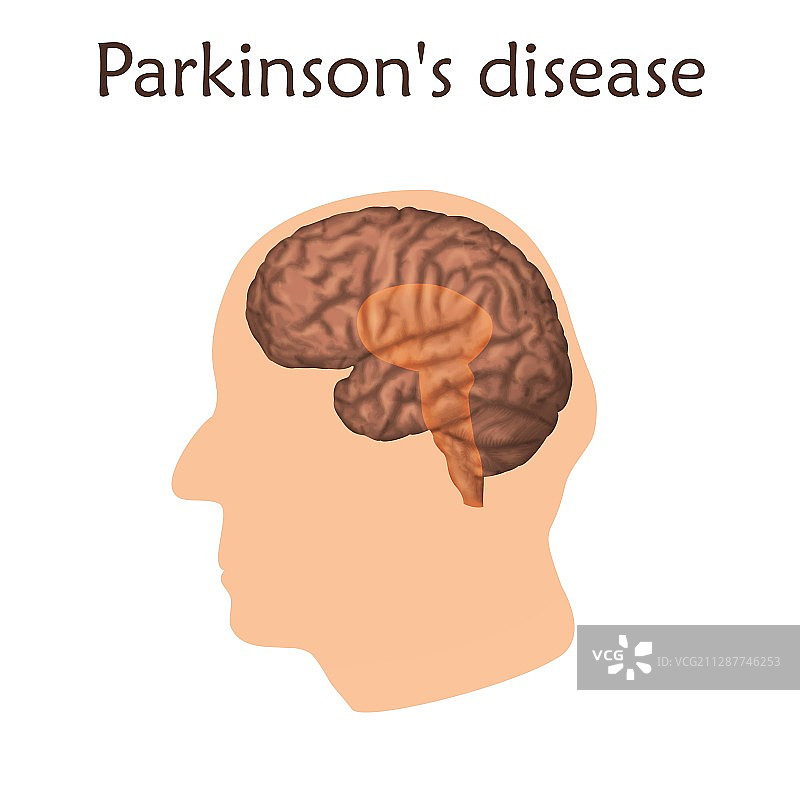 帕金森病插图图片素材