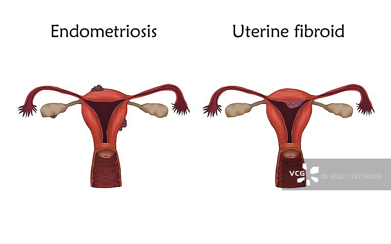 子宫内膜异位症和子宫肌瘤插图图片素材