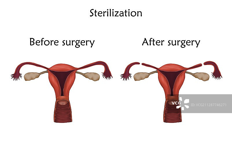 女性绝育插图图片素材