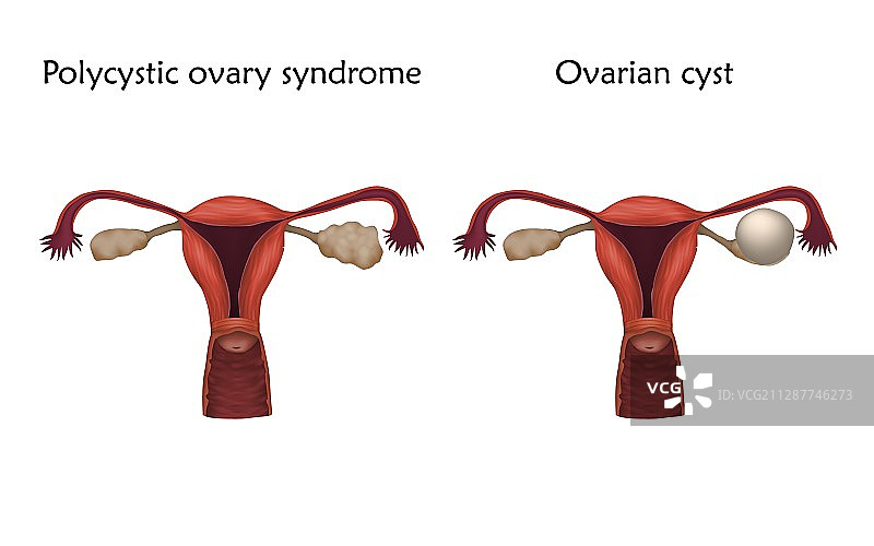 多囊卵巢综合征插图图片素材