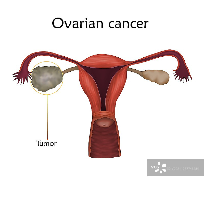 卵巢癌插图图片素材