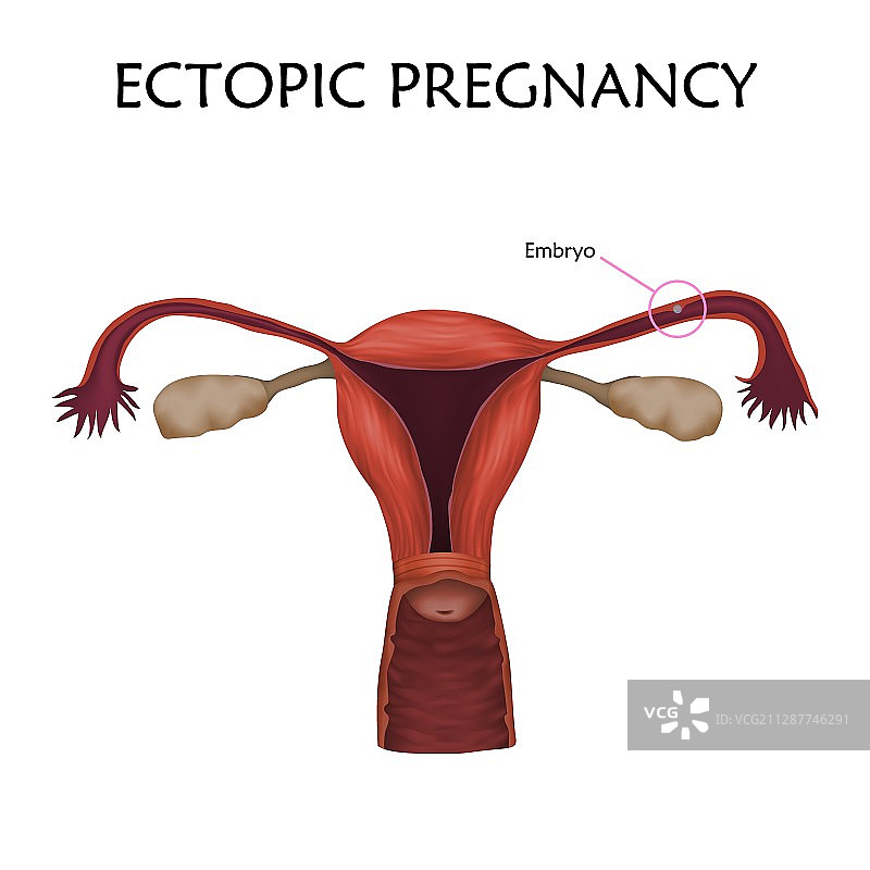 异位妊娠插图图片素材