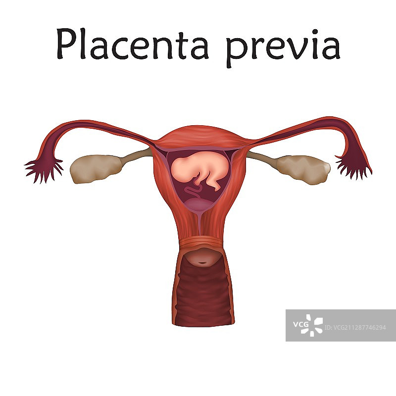 前置胎盘示意图图片素材