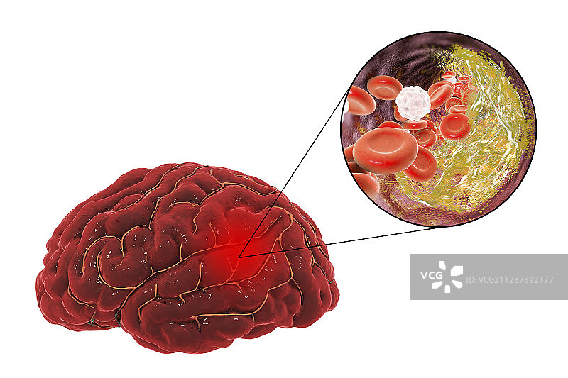 动脉粥样硬化引起的卒中插图图片素材