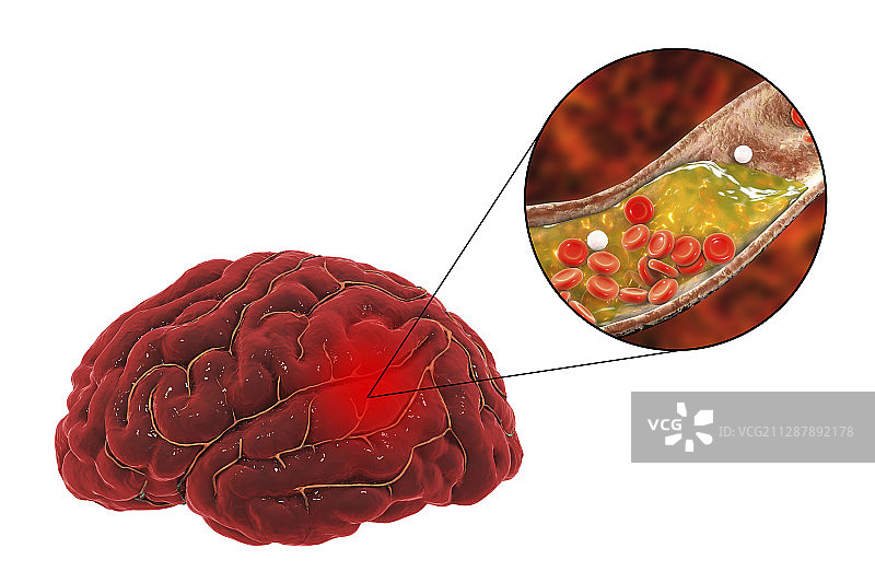 动脉粥样硬化引起的中风概念图图片素材