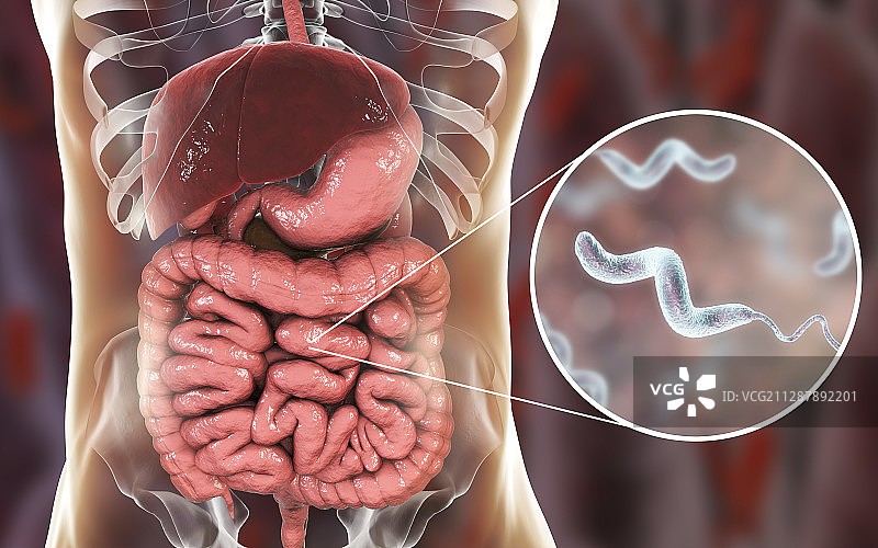 弯曲杆菌病、概念说明图片素材