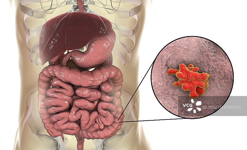大肠内的寄生性阿米巴原虫插图图片素材