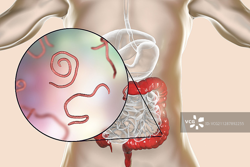蛲虫感染插图图片素材