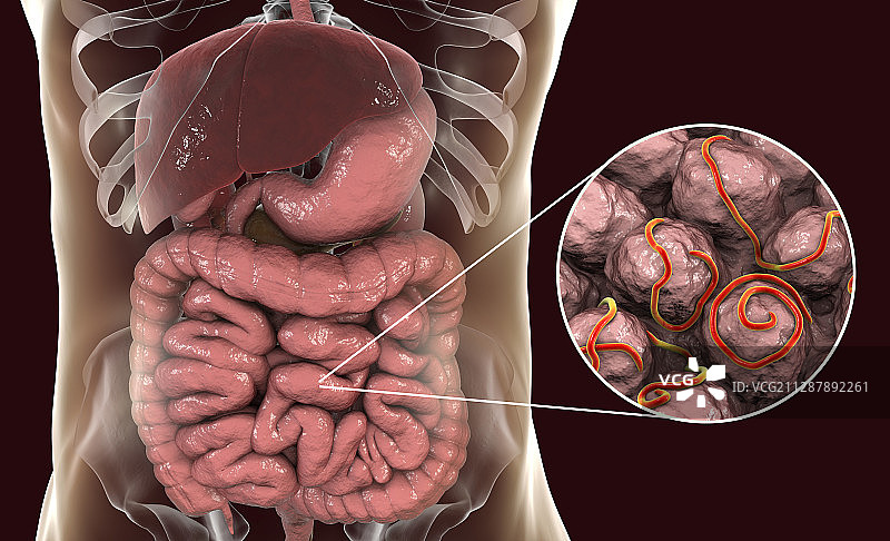 蛲虫感染插图图片素材