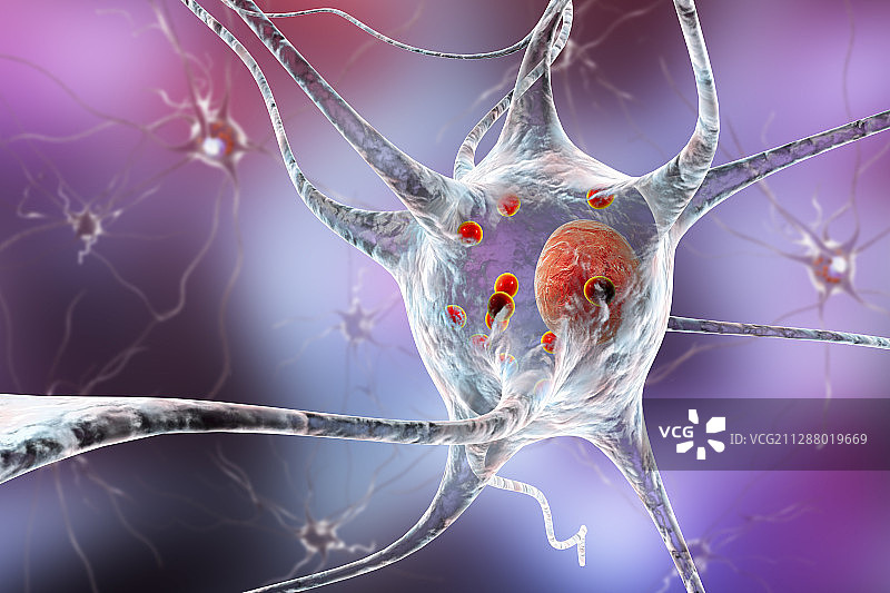 帕金森病神经细胞插图图片素材