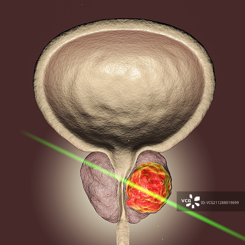 前列腺癌激光疗法概念插画图片素材