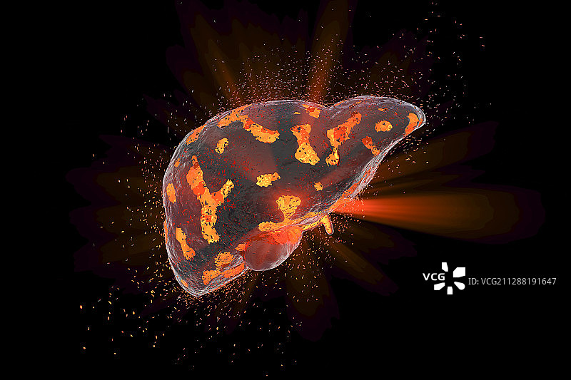 肝脏疾病概念插图图片素材