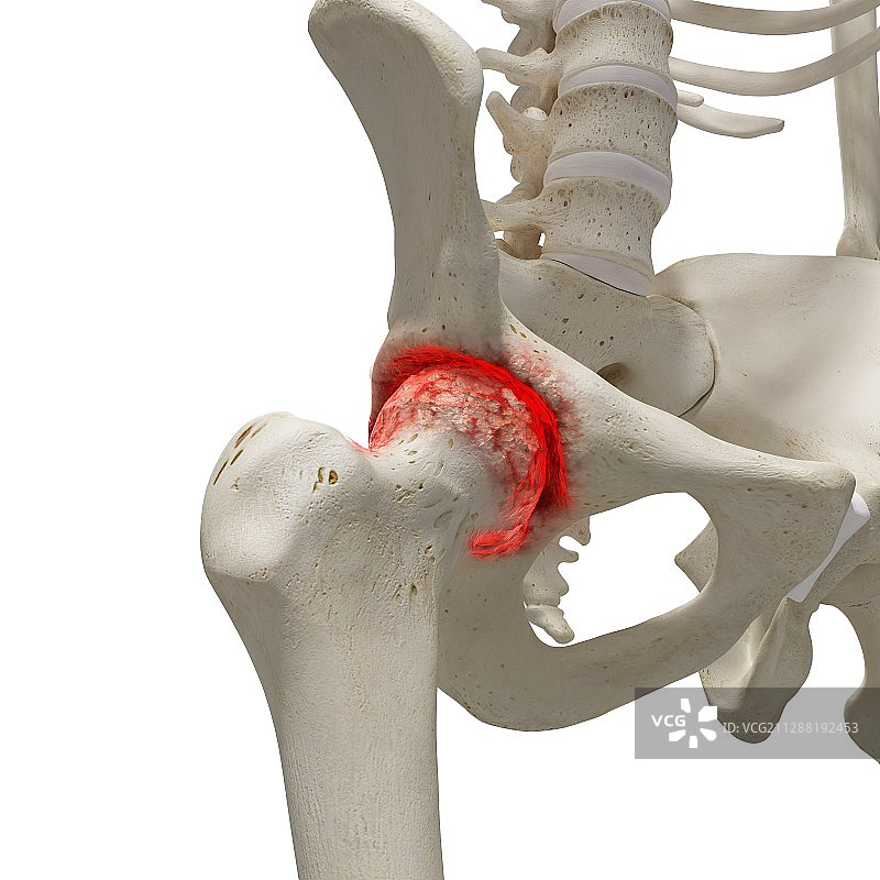 髋关节炎插画图片素材