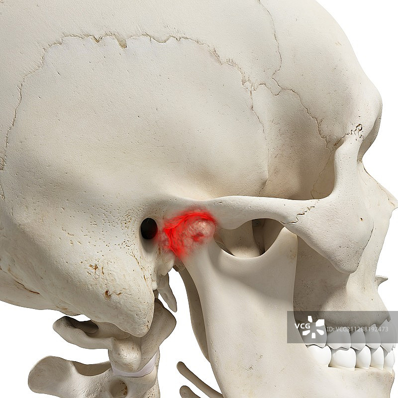 下颌关节炎插图图片素材