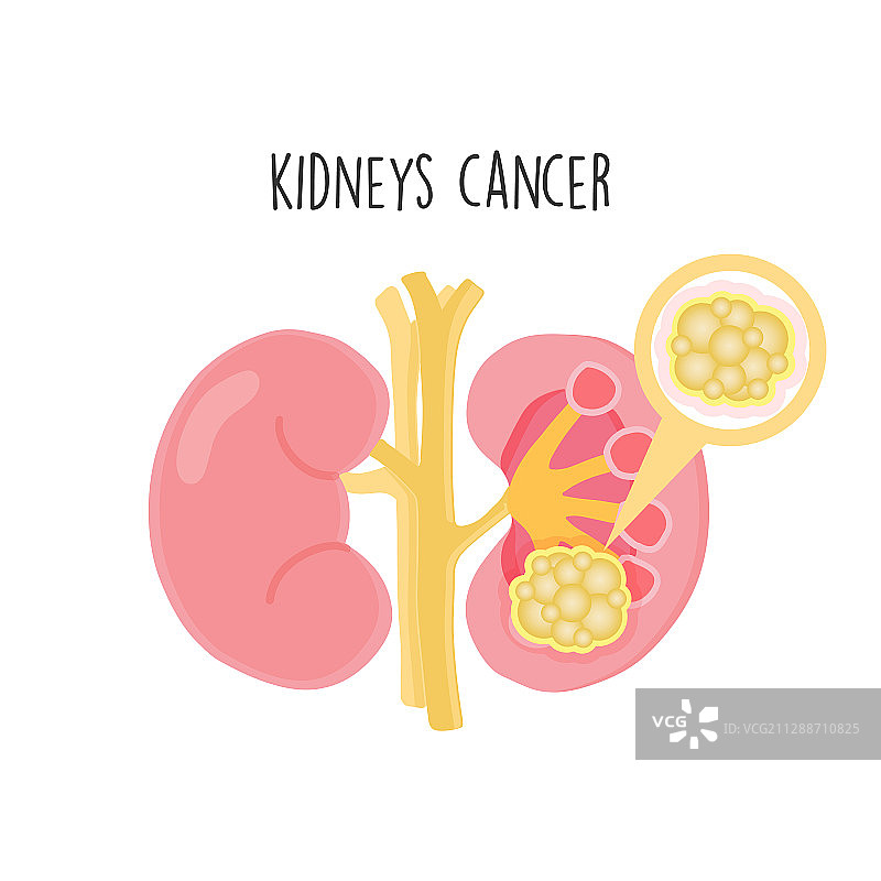 肾癌扁平设计图片素材