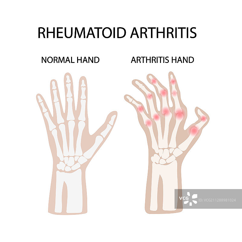 类风湿性关节炎白色医学教育矢量图图片素材